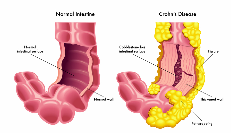 Crohns Disease Exploring Biology 9075