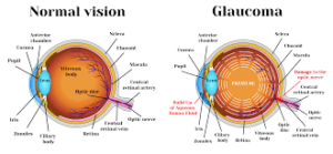 Glaucoma1 Exploring Biology