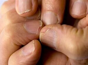 Brittle Nails - Calcium Deficiency 