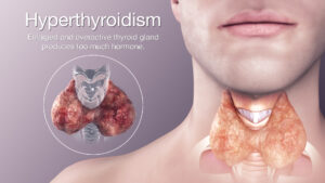 Location of enlarged thyroid gland