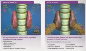 A healthy thyroid on the left and inflamed thyroid on the right