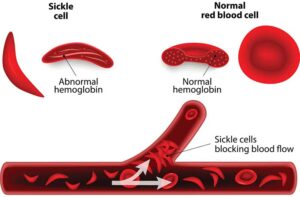 A picture comparing a normal red blood cell to a sickle cell