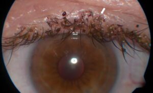 lice located on eye lids