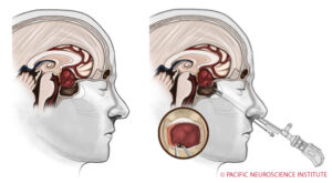 Treatment of Pituitary Tumor with surgery.
