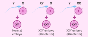 This picture shows the genetic cause of Klinefelter syndrome between the DNA of the sperm and embryo. 