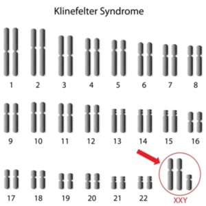 This picture shows how men with Klinefelter Syndrome have an extra X chromosome in one set of their DNA.