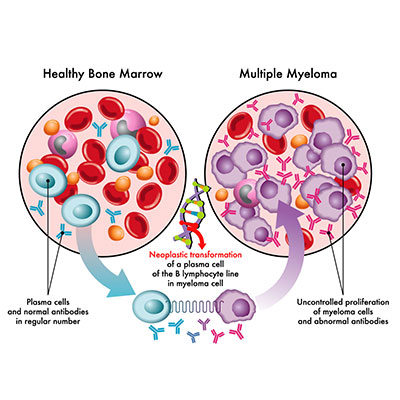 The image above shows the difference between healthy bone marrow and bone marrow infected with Multiple Myeloma