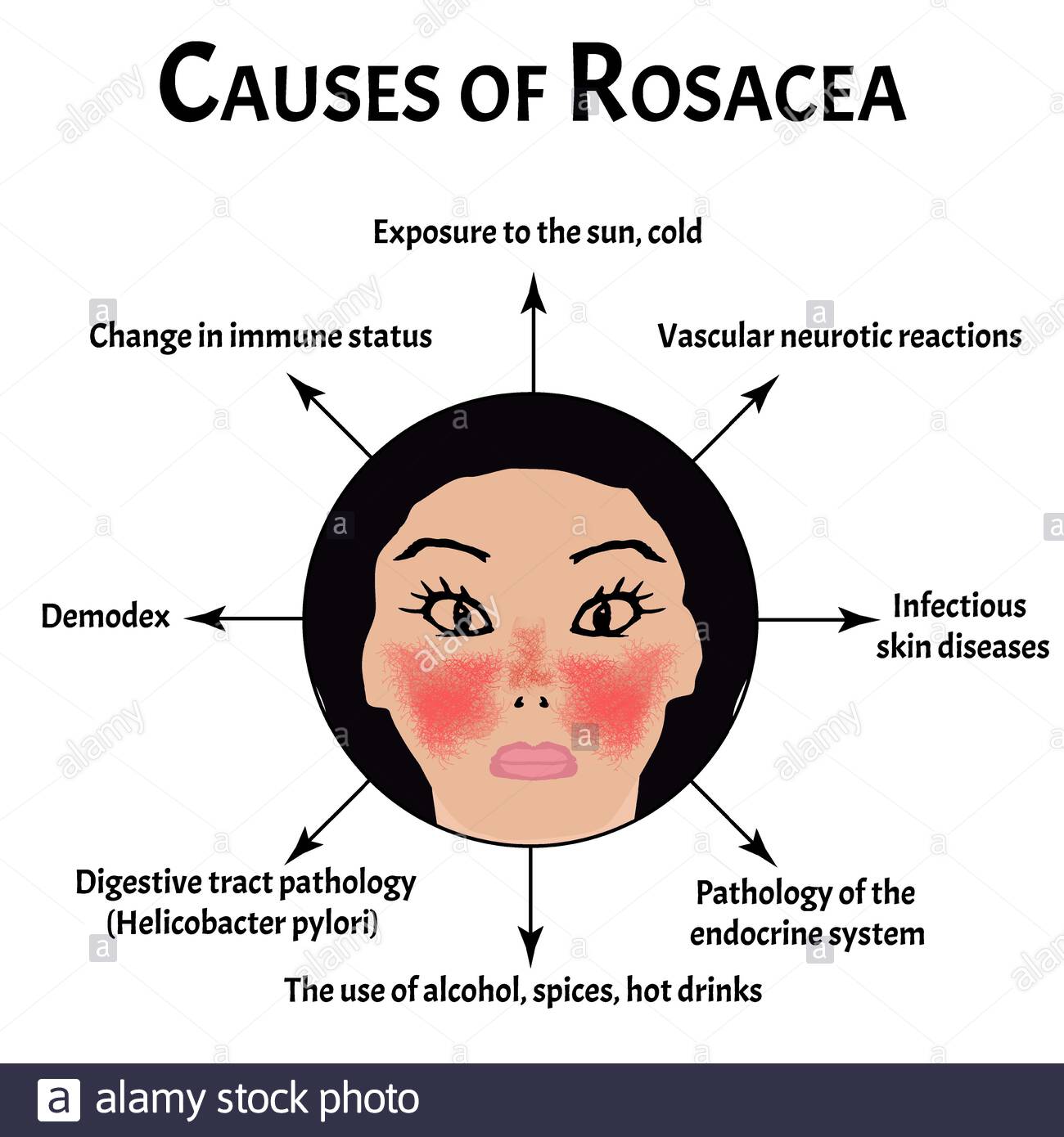 Rosacea – Exploring Biology