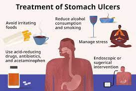 Peptic Ulcer – Exploring Biology