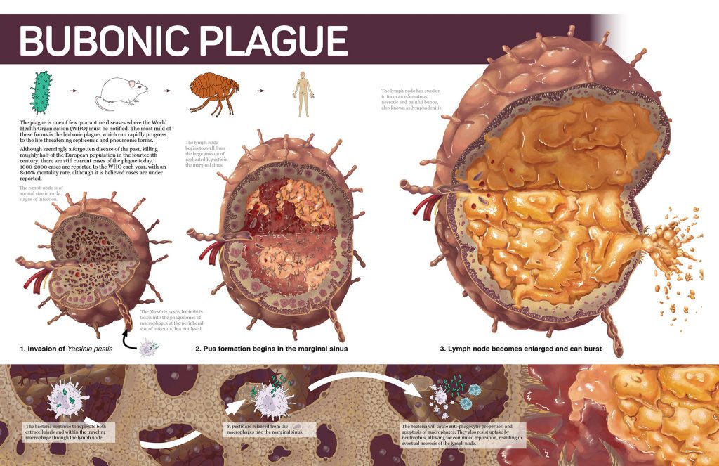 Bubonic plague Exploring Microbial Diseases